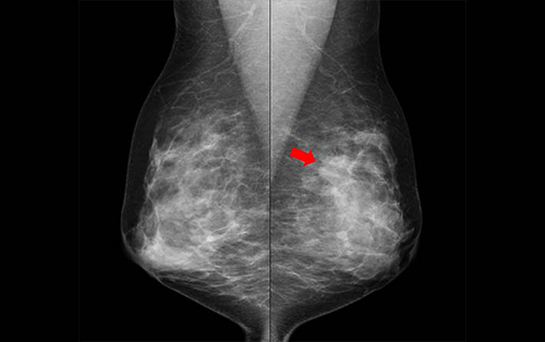 濃度の高い乳腺に発見された乳がん